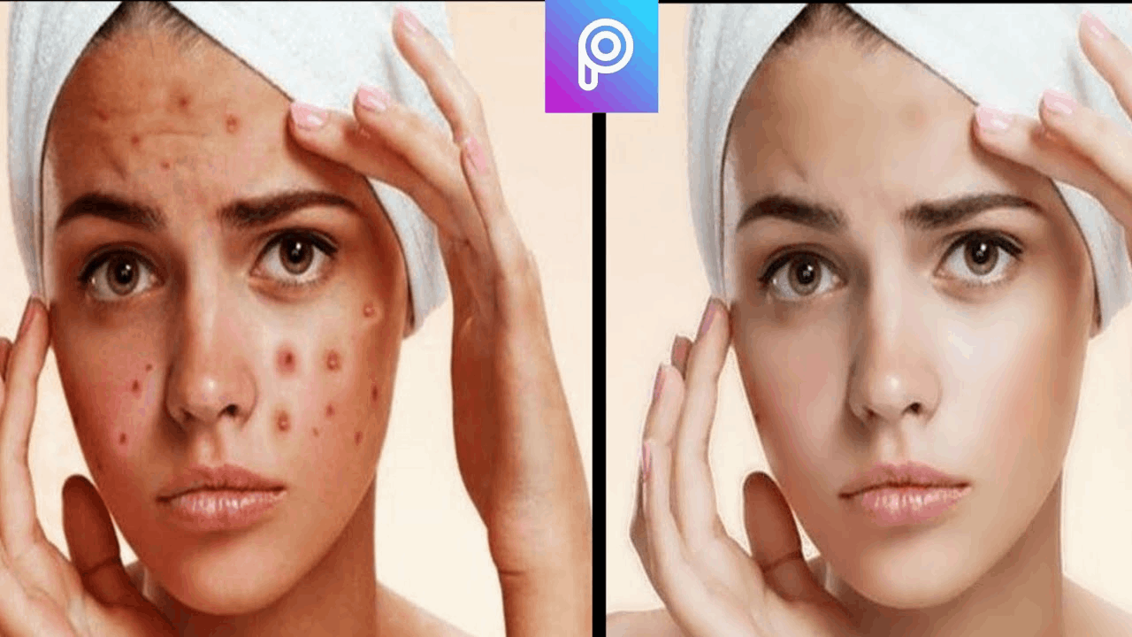 Find Out How to Get Rid of Pimples and Marks on Photos with an App - Picsart